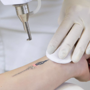 Eliminación de tatuajes