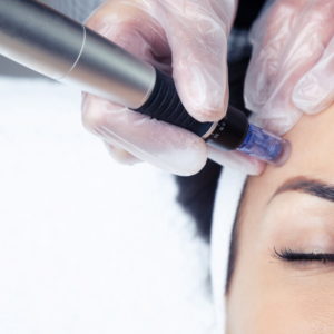 Bono 3 sesiones Dermapen Exosomas
